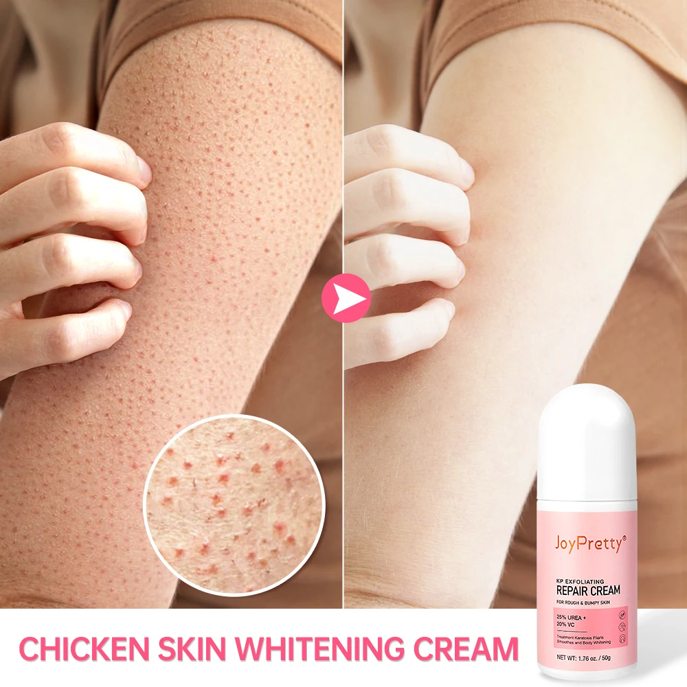 

Chicken Skin Removal Cream Body Curing Keratosis Follicle Pore Spot Dull Treatment Whitening Moisturizing Body Care JoyPretty