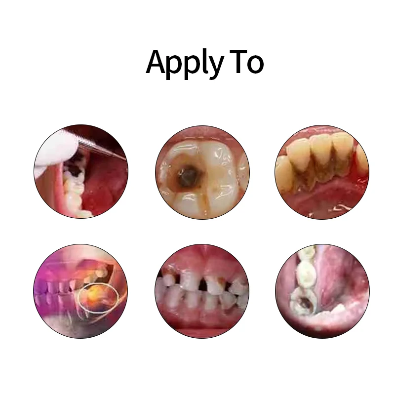 Quick Repair of Cavities Caries Removal of Plaque Stains Decay Whitening Yellowing Repair Teeth Whitening Tooth Pain Relief