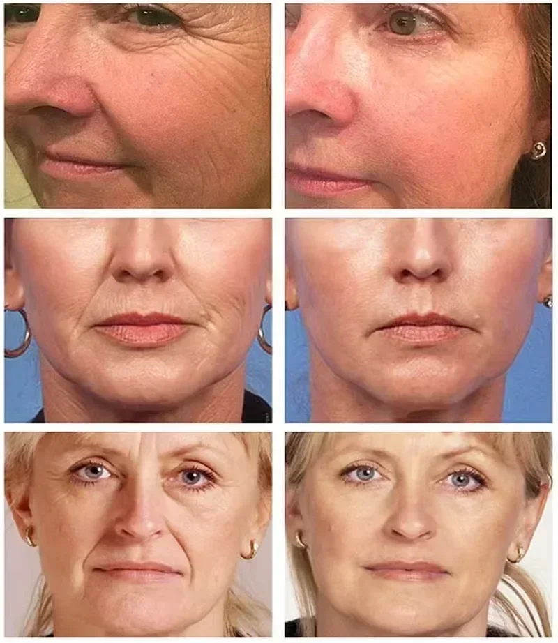 Effet anti-déformable instantané pour le visage, élimine les déformations du visage, estompe les ridules, raffermissant, raffermissant, soins de la peau, cosmétique coréen