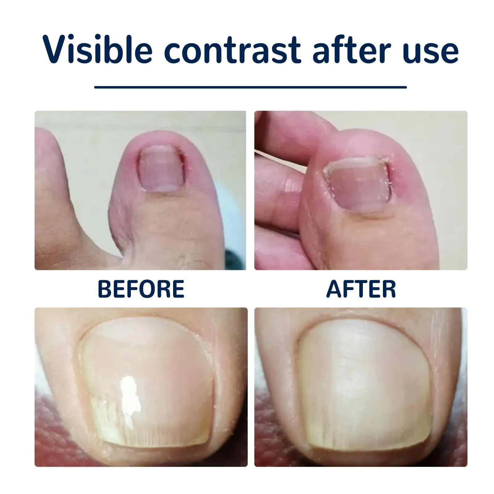 발톱 교정기용 통기성 탄성 스트립 내성발톱용 강력한 접착력 발톱 교정에 사용하기 쉬움