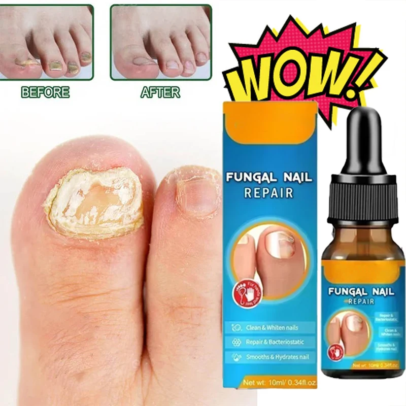 Traitement Antifongique des Ongles, Soin des Pieds, Essence Anti betection, Paronyamitié, Onychomycose, Réparation des Ongles, Parker Fungus Serum, Élimination Fongique