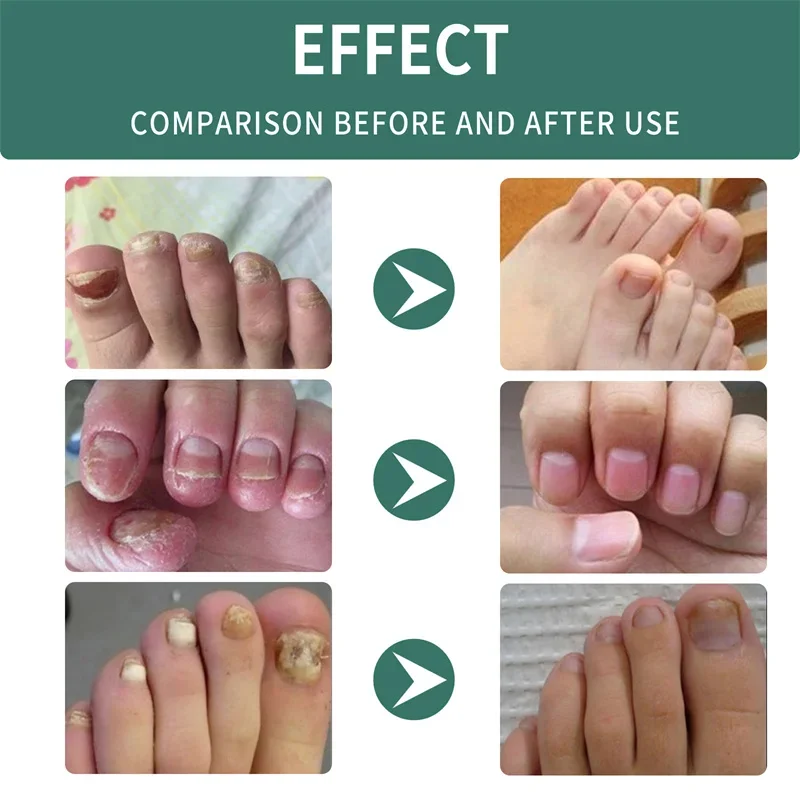 Nail Fungus Treatments Serum Spray Repair Toe Nail Fungal Removal Essence Anti-infection Onychomycosis Paronychia Treatment Gel