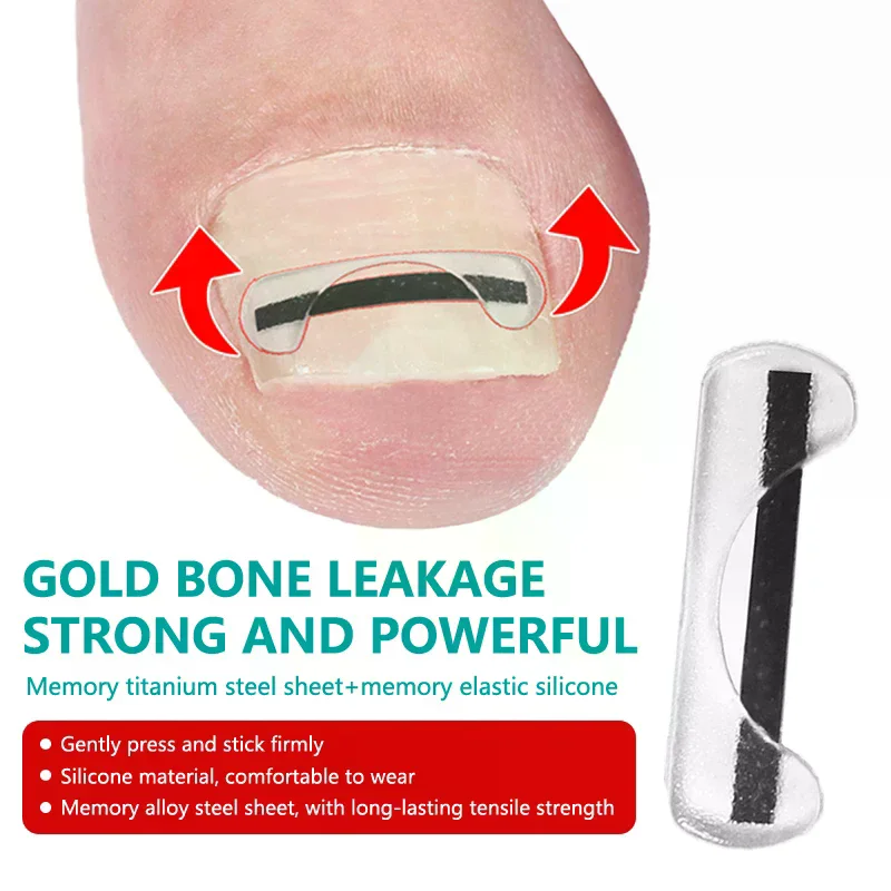 Fil de Correction des ongles incarnés en alliage de titane, dispositif de traitement des ongles, autocollants, outil en Silicone, accessoires de soins des pieds, usage quotidien