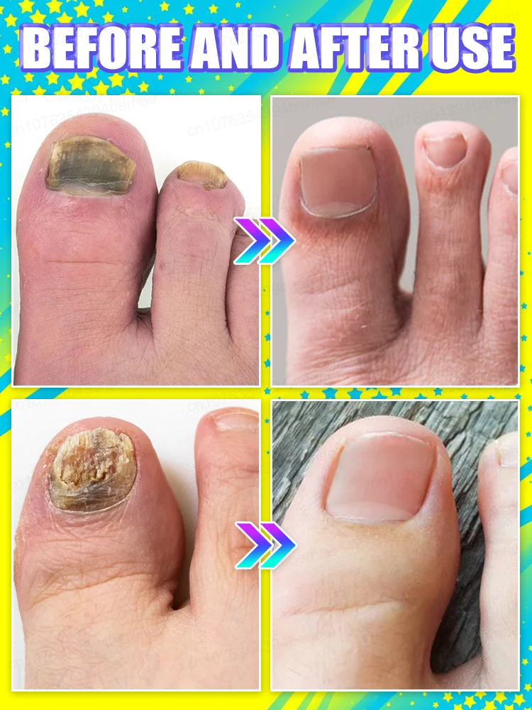 ᴰᵒⁿ’ᵗ ˡᵉᵗ ᵒⁿʸᶜʰᵒᵐʸᶜᵒˢⁱˢ turn into rotten nails! Intervene early
