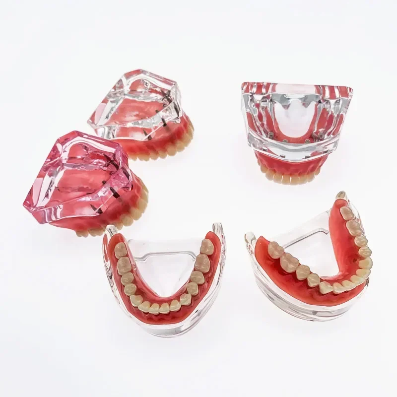 Dental Overdenture Superior upper/Lower jaw for Teaching Study 4 Implants/2 Implants Teeth Model