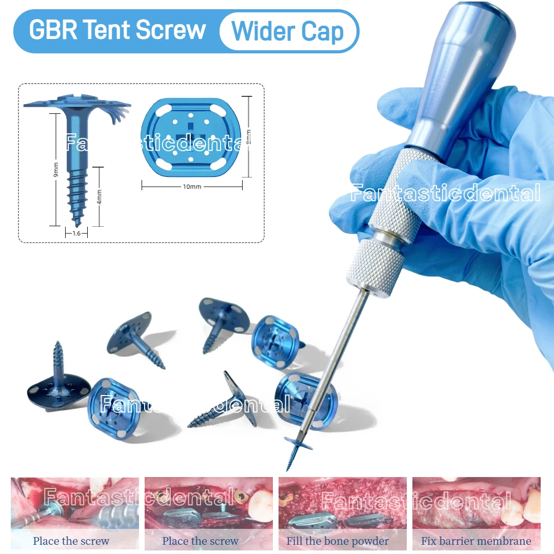 Dental GBR Bone Tent Screw Wide Cap Half Thread Tenting Screw Universal Handle DriverTip Guide Bone Regeneration Membrane Shield