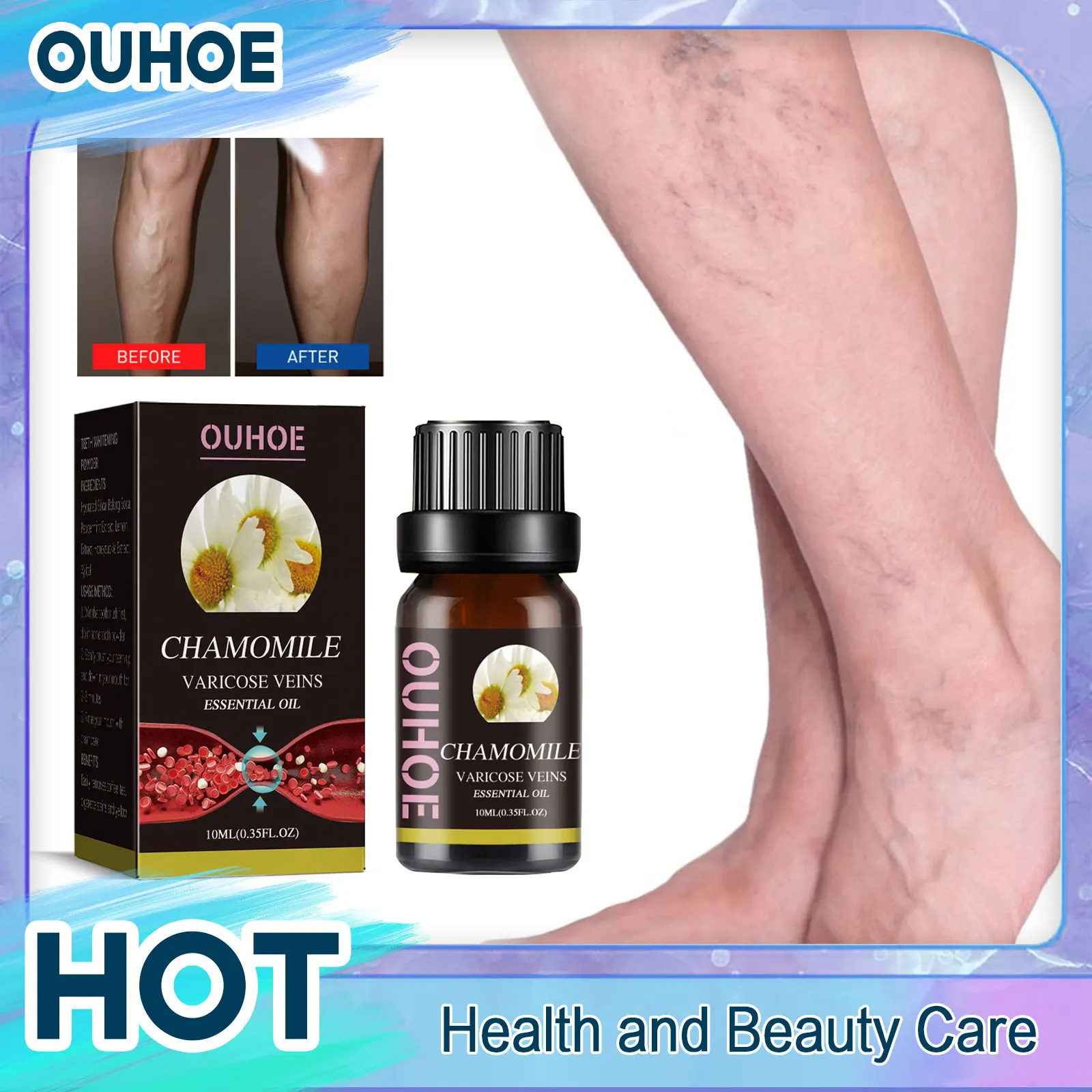 Angiitis Remedy Oil Anti Swelling Phlebitis Spider Pain Treatment Dilated Vasculitis Earthworm Legs Varicose Vein Essence 10ml