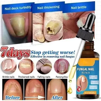 Fungal Nail Treatment Oil Foot Repair Essence Toe Nail Fungus Removal Gel Anti Infection Cream Fungal Nail Removal Paronychia