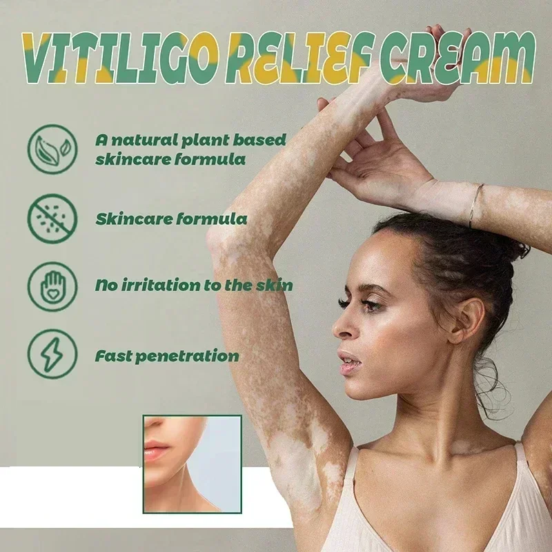 Improve Skin Pigmentation and Reduce White Spots Vitiligo Treatment Cream