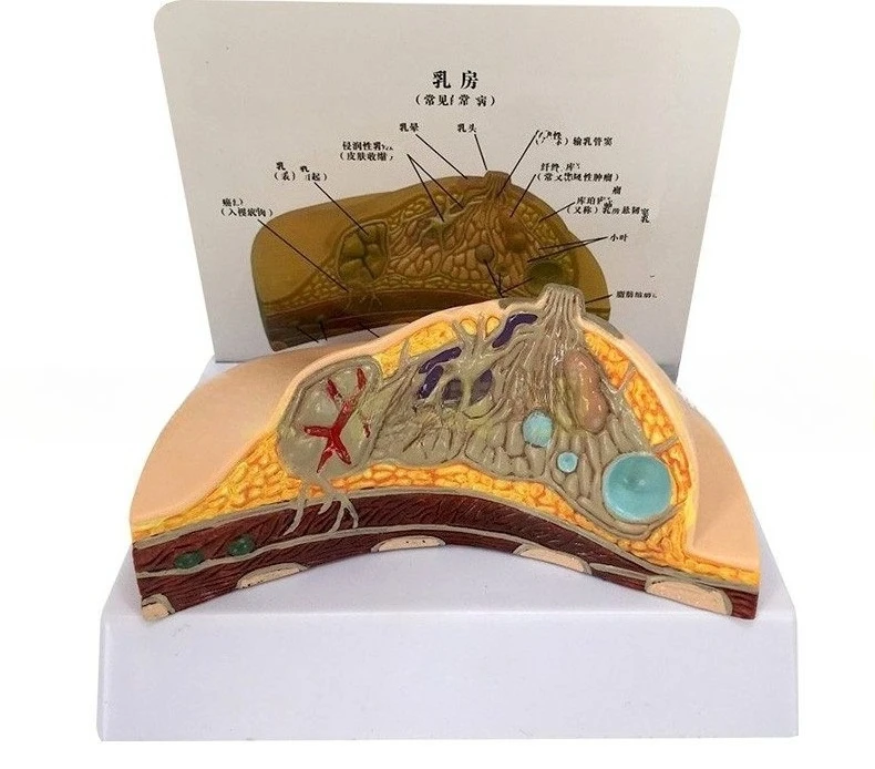 Breast pathological anatomy model