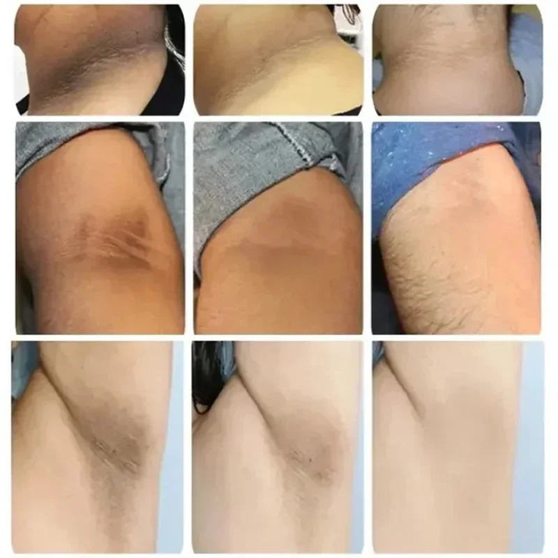 130 جرام/260 جرام/390 جرام حمض الكركم كوجيك صابون يدوي الصنع علاج حب الشباب تبييض تحت الإبط تقشير تقليل بلادة العناية بالبشرة النظيفة العميقة