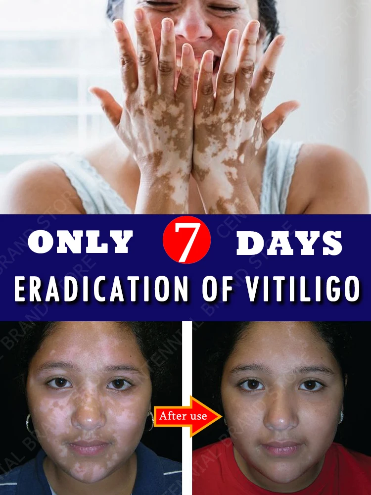 

Vitiligo ointment is effective in repairing the skin