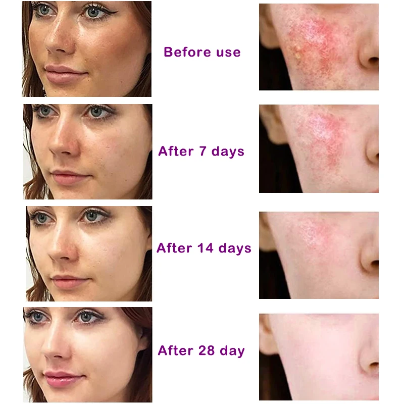 Freckles Removal Moisturizing Whitening Cream Face