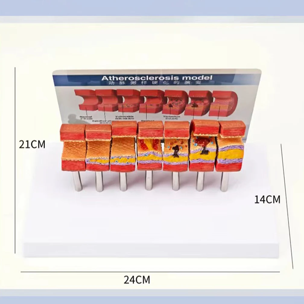 7 Stages In 1 Arterial Vessel Atherosclerosis Model Middle-Aged And Elderly Blood Vessel Structure Anatomia Models Medical Set