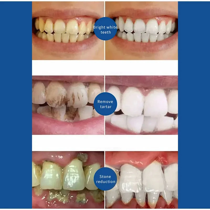 Removedor de Cálculo Dentário, Clareamento Dentário Dentário, Boca Remoção De Odor, Mau Hálito, Prevenção De Periodontite, Removedor De Placa