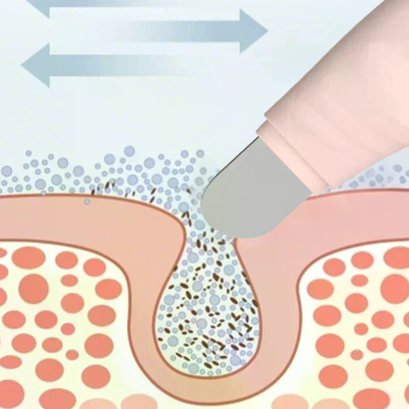 Facial Mee-eter Removal Tool Gezicht Schraper Voor Diepe Reiniging Gezicht Acne Foundation Spatel Neus Whitehead Remover Huidverzorging Tool