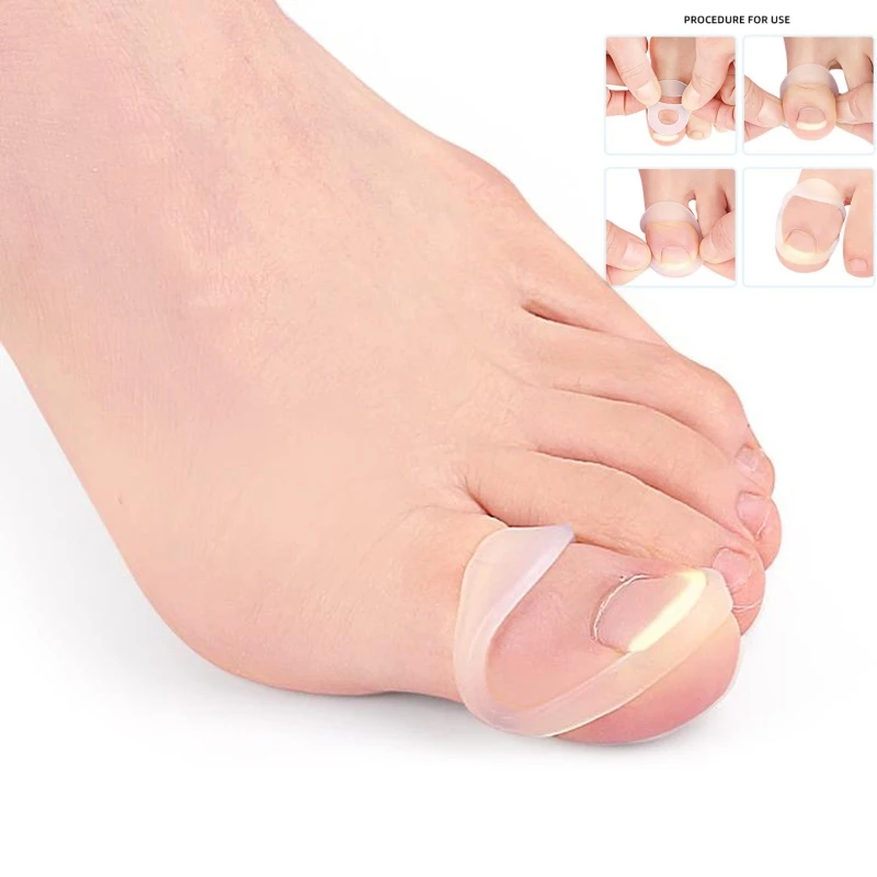 Outil de Correction des ongles incarnés en Silicone, traitement des ongles incarnés invisibles, Clip de redressage élastique, outil de pédicure
