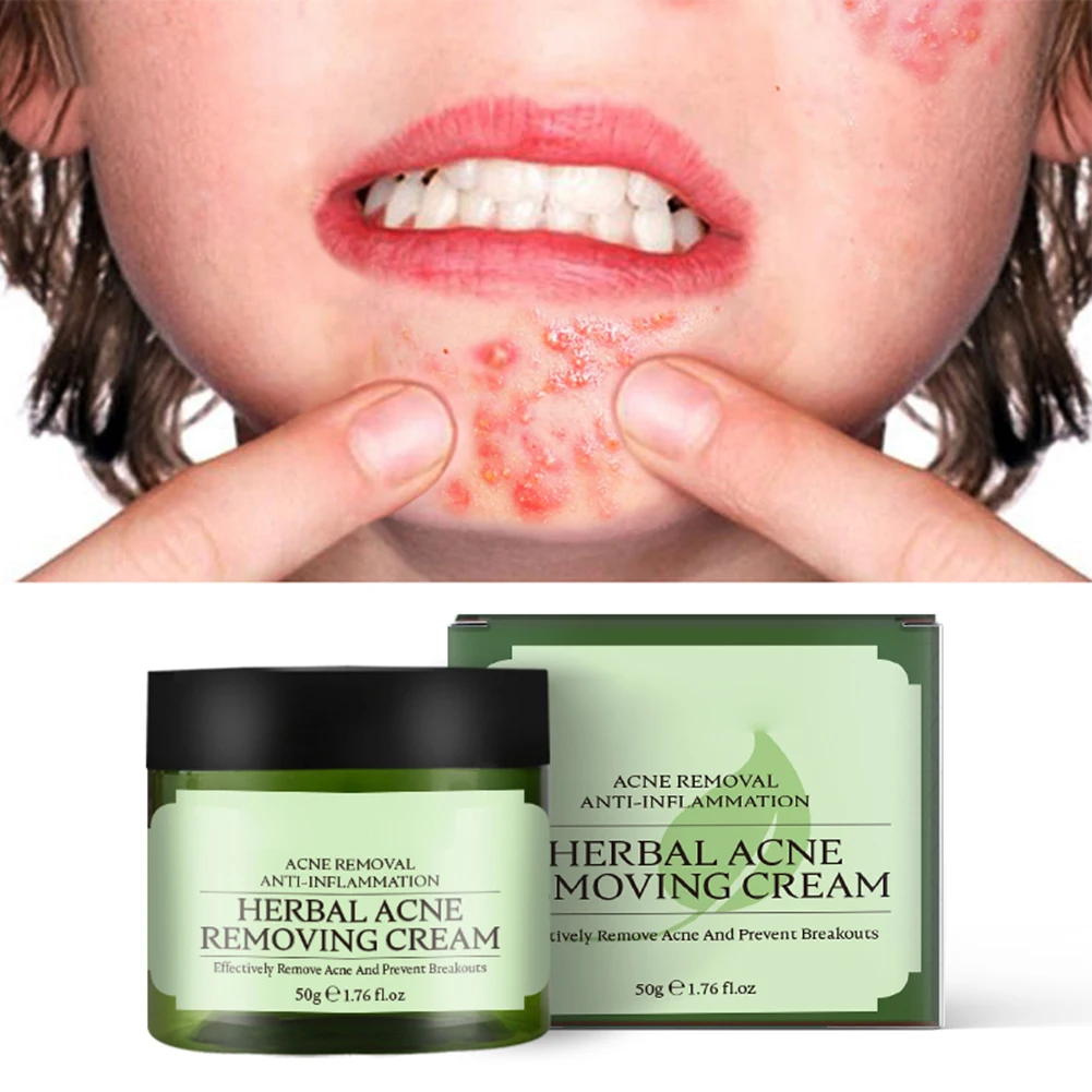 

50g Herbal Acne Treatment Remove Cream Prevent Blend Pores Shrink Oil Control Roughness Refresh Skin Care Beauty Health Texture