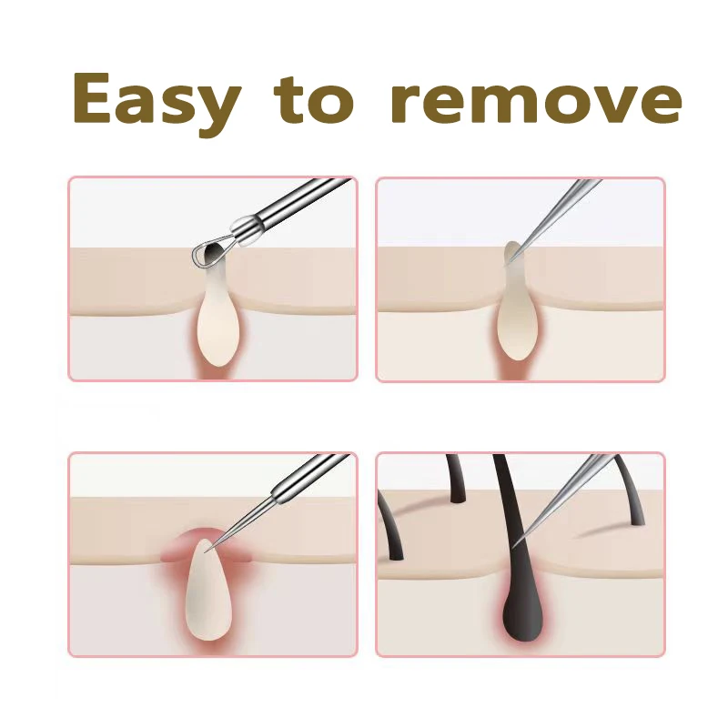 Acne Needle Remove 4pcs/set Blackhead Blemish Pimple Comedone Stainless Steel Acne Remover Facial Cleaning Pimple Remover Tool