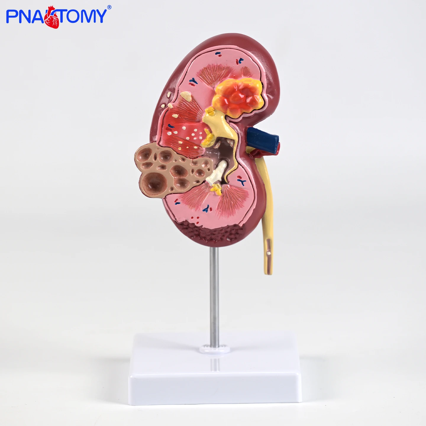 

Pathological Kidney Model Kidney Model human organ Model