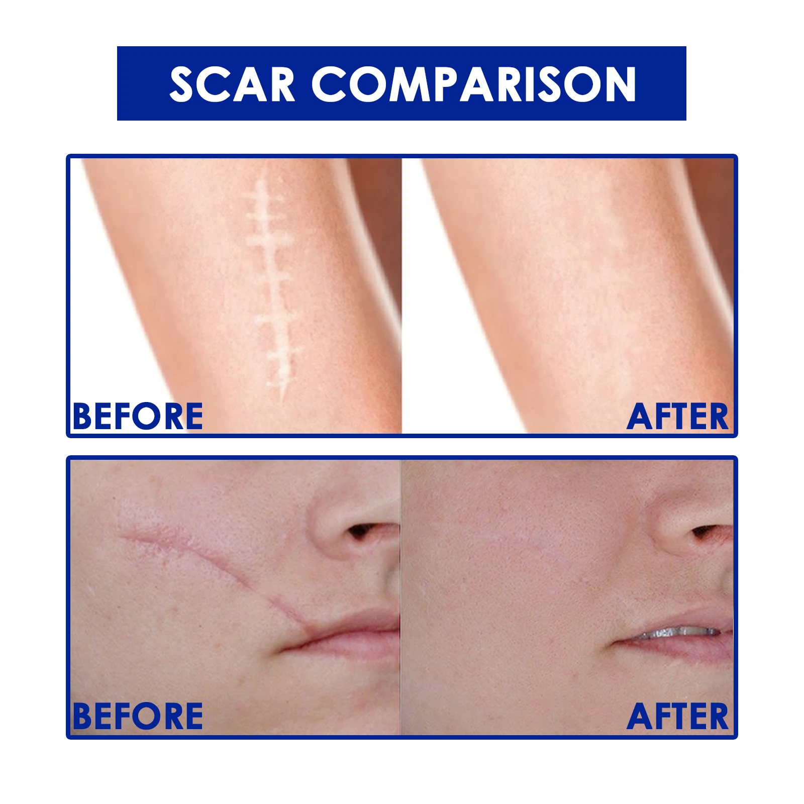 Scar Repair Cream Stretch Mark Removal Cream Repair Cream For Obesity And Growth Lines Burn Surgery Scars Restore Skin Cream New