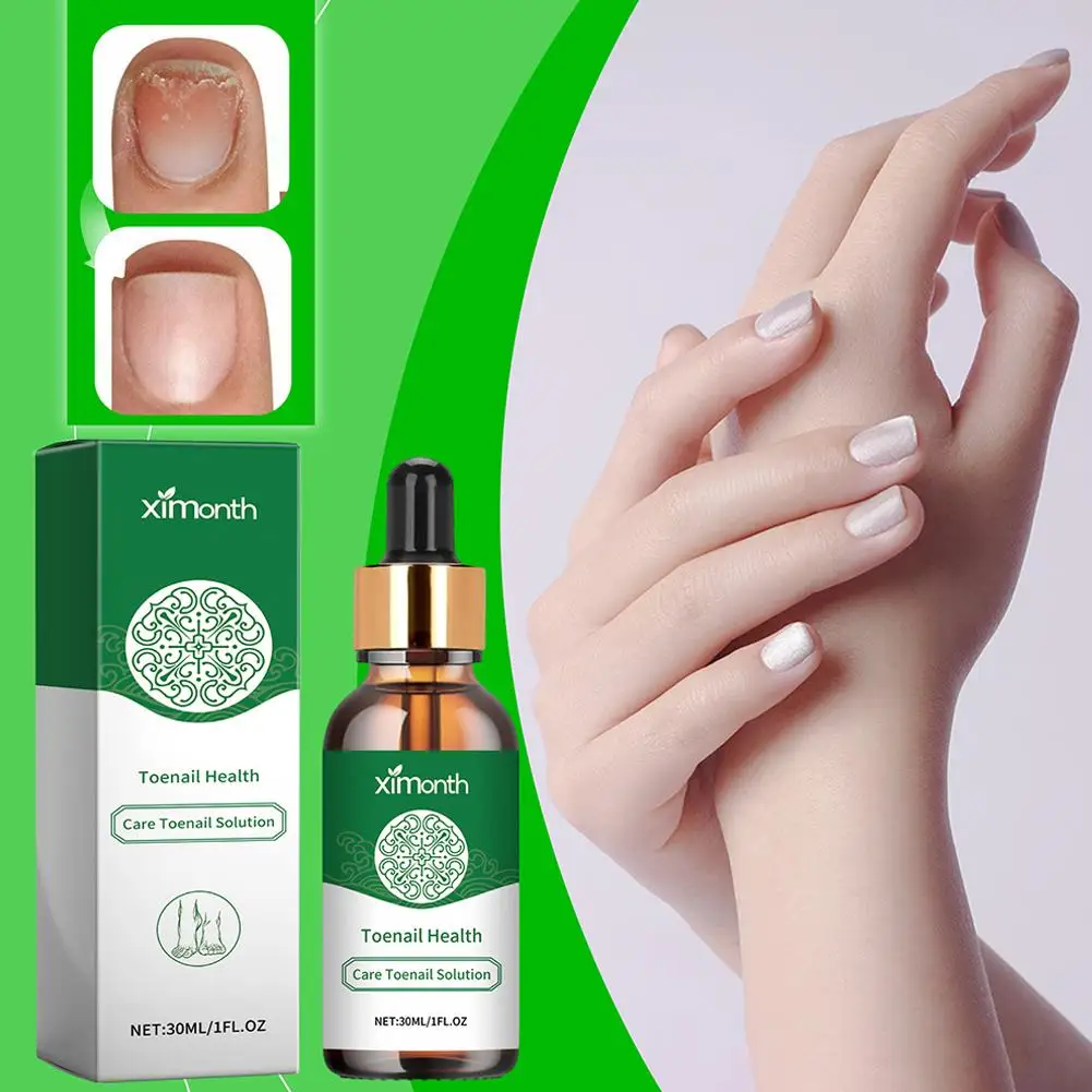 30ML Nail Fungal Treatment Essence Oil Foot Toe Nail Care Infection Onychomycosis Anti Beauty Removal Fungus Serum Gel Heal D6L3