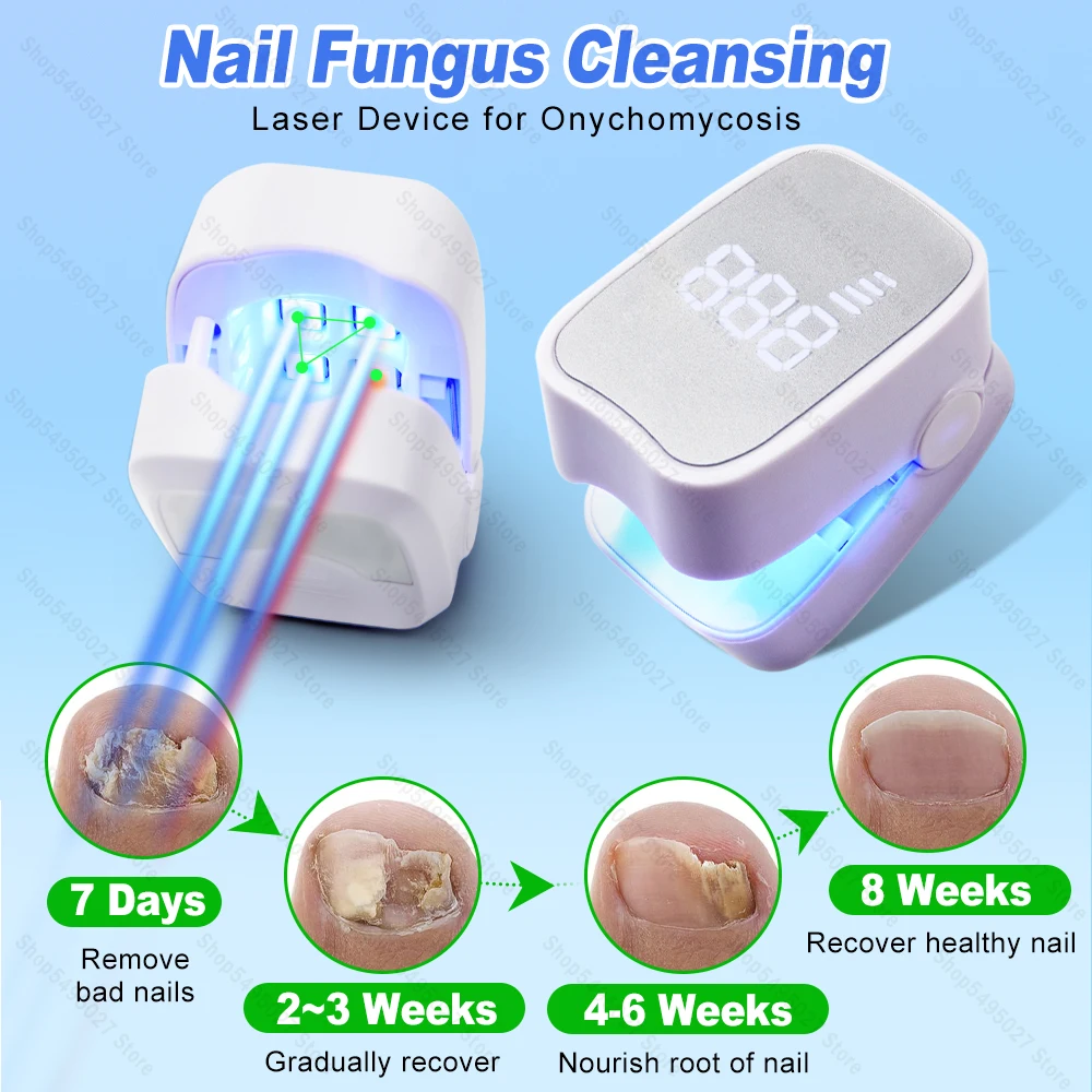 

Nail Fungus Laser Treatment Device Repair Effectively Remove Nail Fungal Infection Anti-Equipment Nail Fungus Treatment Tools