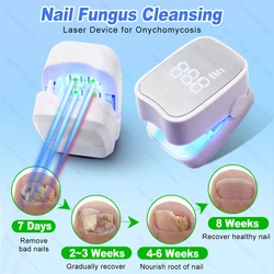 Nail Fungus Laser Treatment Device Repair Effectively Remove Nail Fungal Infection Anti-Equipment Nail Fungus Treatment Tools