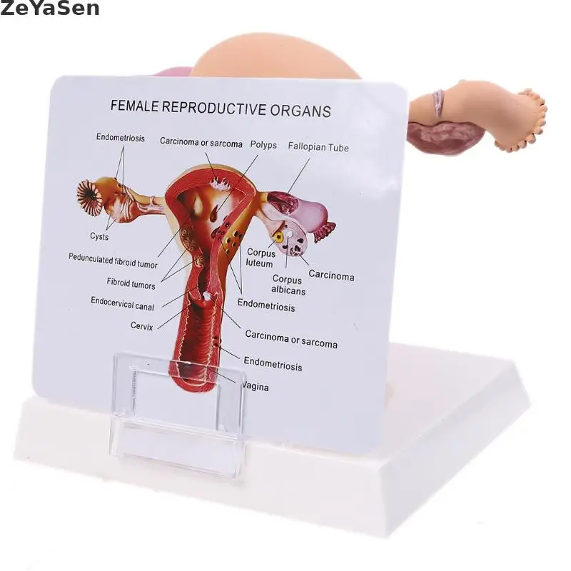 Medical props model Human Female Pathological Uterus Ovary Model Anatomical Disease Pathology Medical Lesion ForBiology Teaching