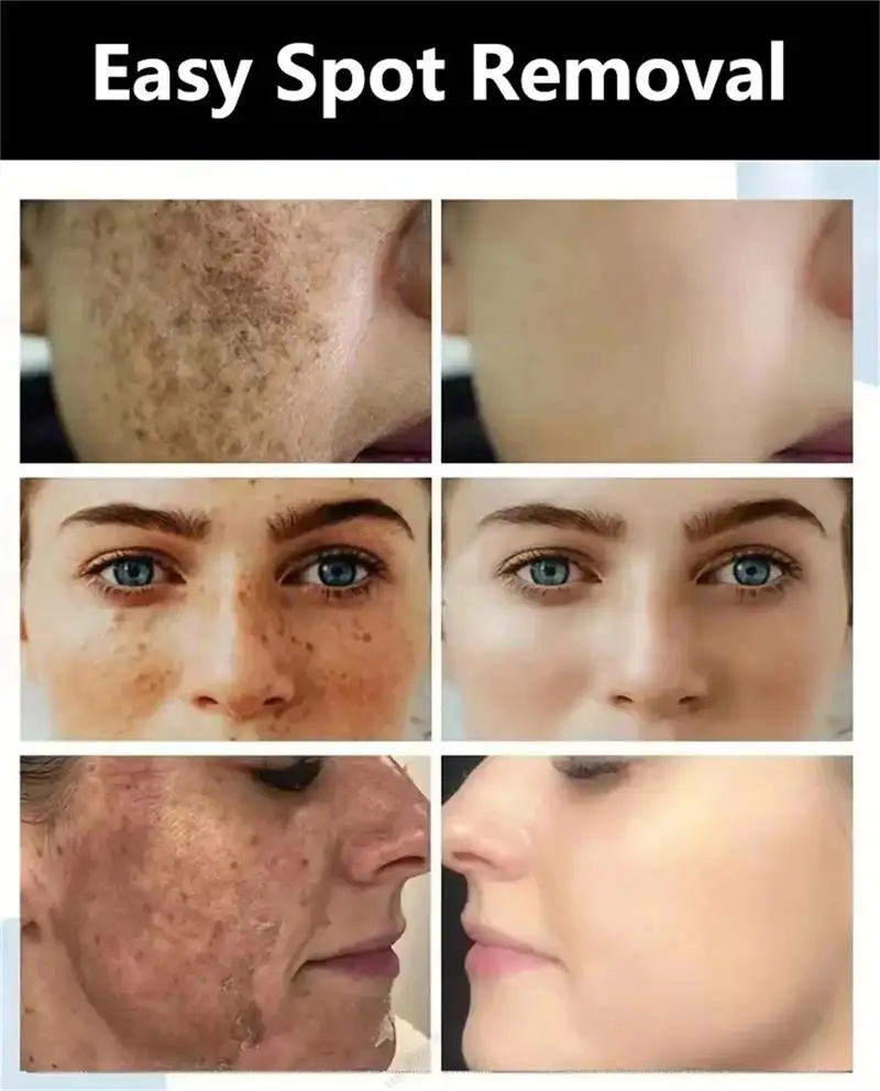 Serum pemutih wajah, penghilang bintik wajah, produk perawatan kulit, esens Anti Penuaan, Mencerahkan Melanin, Melasma, bintik hitam