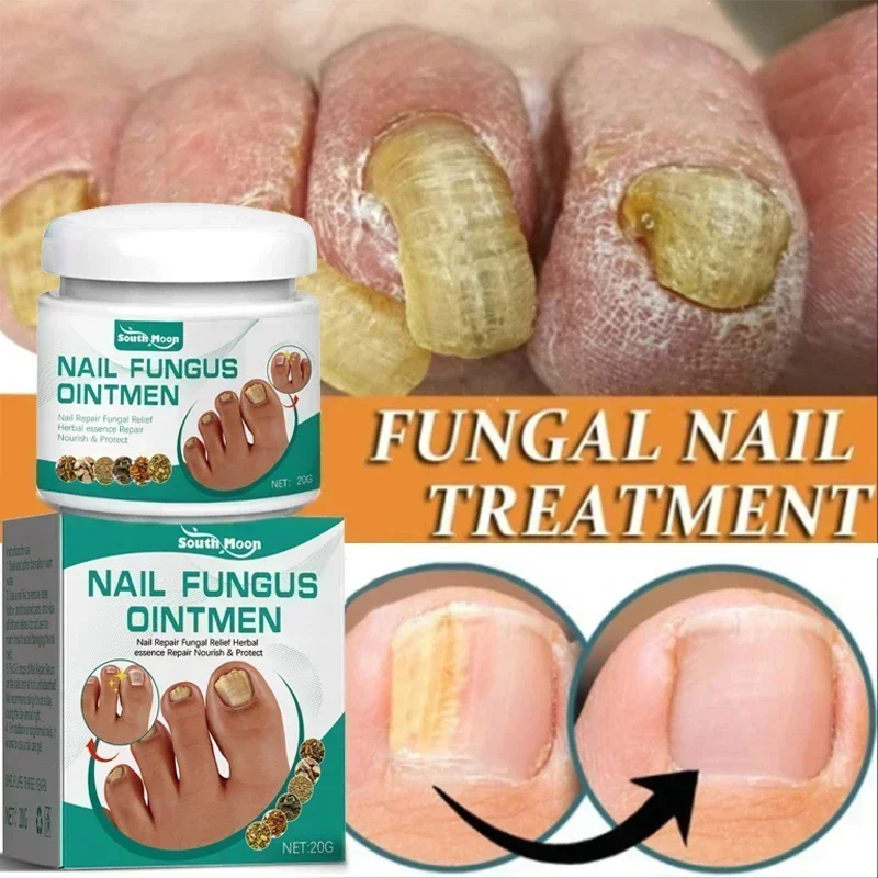 ขายร้อนเล็บ Fungal Treatment เท้าเชื้อราเล็บกําจัด 7 วันซ่อม Onychomycosi Anti Infection GEL Care Prod