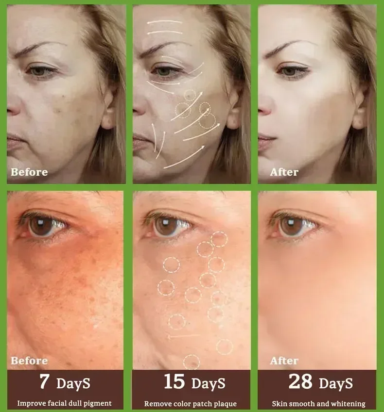 Freckles Removal Cream Remove Skin Dark Spot  Melasma Age Spots Sunspots Whitening And Freckle Removing Cream