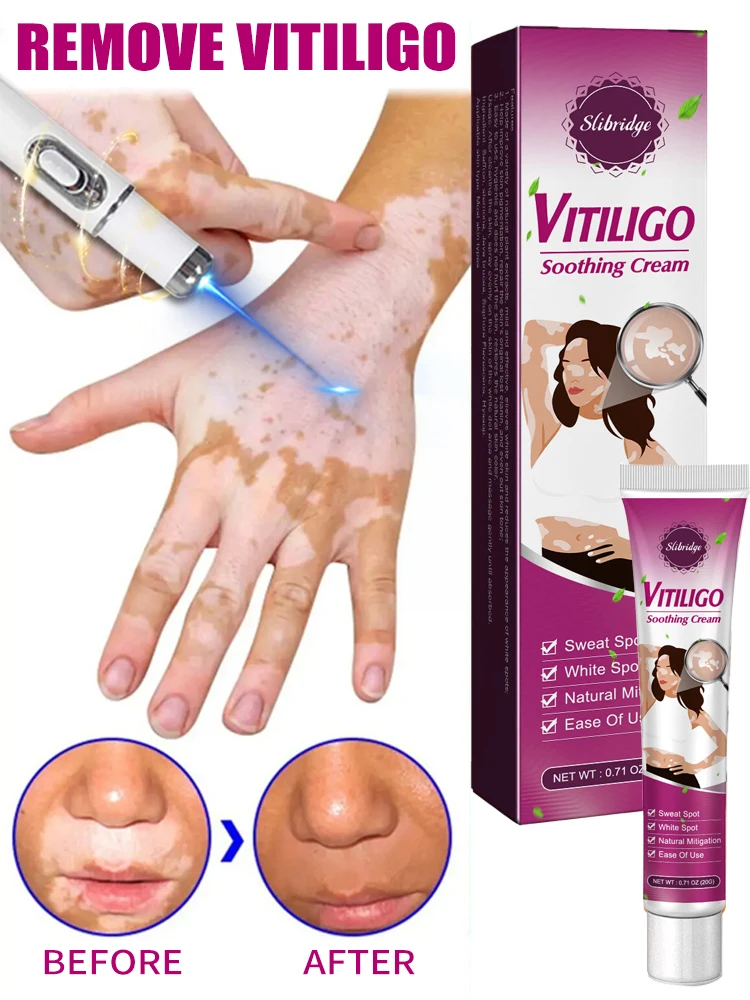 

Improve vitiligo laser