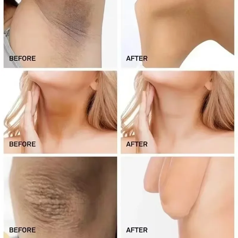 Quickly Whitening Cream Remove Melanin Dark Skin Brightening Cream Underarm Inner Thighs Elbows Bleach Joint Whitening Cream