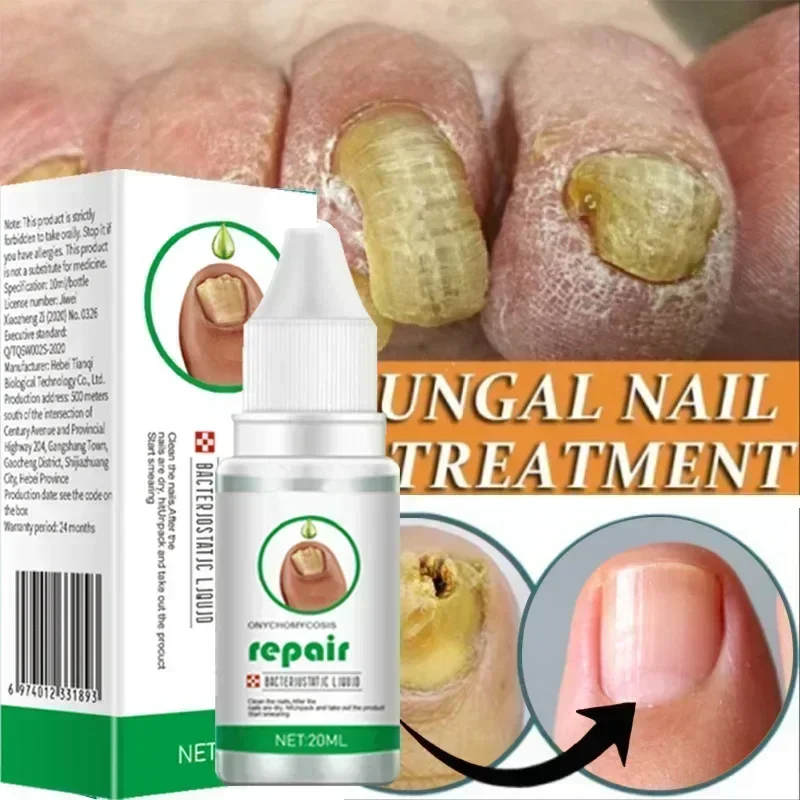 Suero para tratamiento de hongos en las uñas, productos de reparación de hongos en los dedos, Gel de eliminación para el cuidado de los pies y las manos, antiinfección, onicomicosis, paroniquia