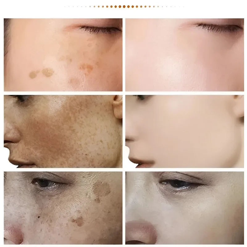 ครีมบำรุงผิวเพื่อความงาม CLEA & nsing melasma ช่วยลดเมลานินแห้งหมองคล้ำสำหรับผู้หญิงครีมบำรุงผิวยกกระชับความชุ่มชื้น