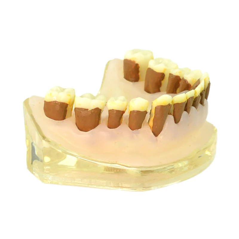 

Dental Teeth Model Periodontal Disease Teeth Model Periodontitis Model Dentist Communication Model