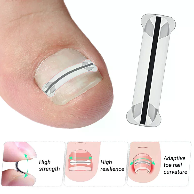 Autocollants correcteurs d'ongles incarnés, 1 pièce, patchs auxiliaires invisibles à haute résistance, traitement Paronychia