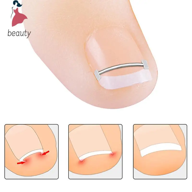 Corrector de uñas encarnadas, herramienta de pedicura, tratamiento profesional de uñas encarnadas, Clip alisador