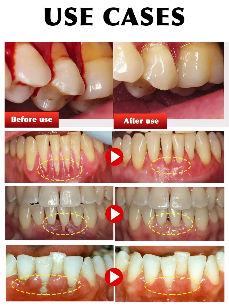 Para reparar dor de dente danificada, reparar dentes danificados, aliviar a dor