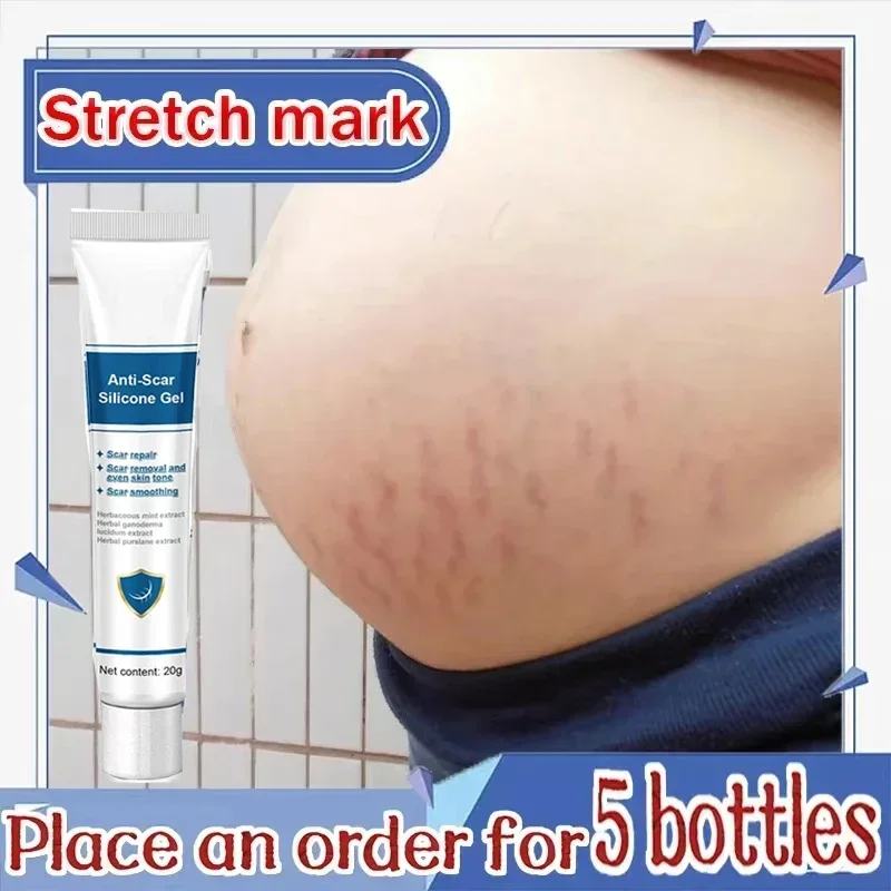 

Cream For Pregnancy Stretch Marks Removal Eliminate Red White Old Stretch Marks Oil