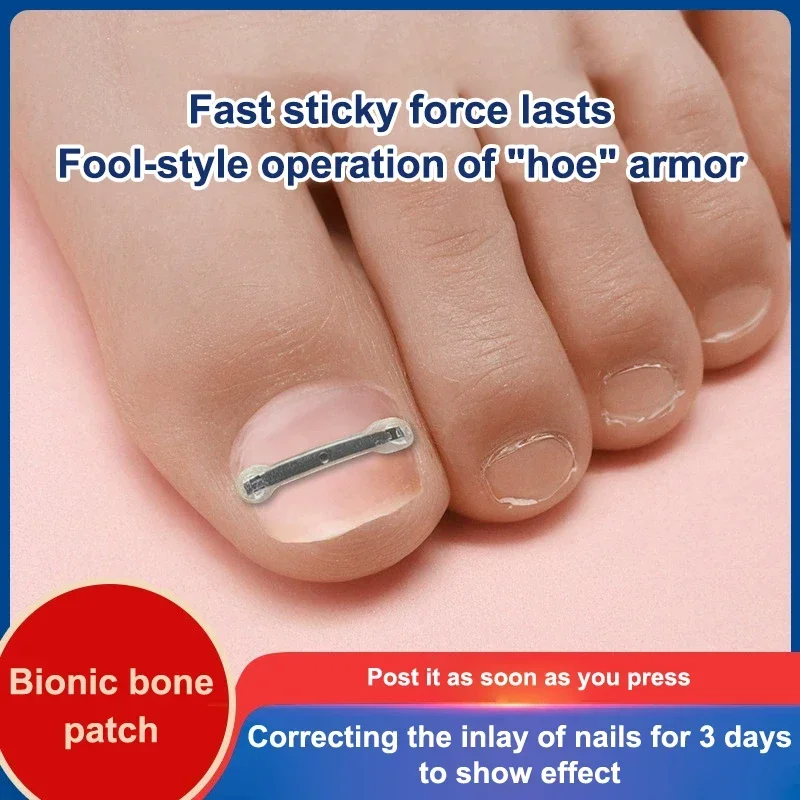 12個入り陥入爪治療キット、4つのマルチサイズ、チタン合金陥入爪矯正ツール、湾曲した爪矯正用