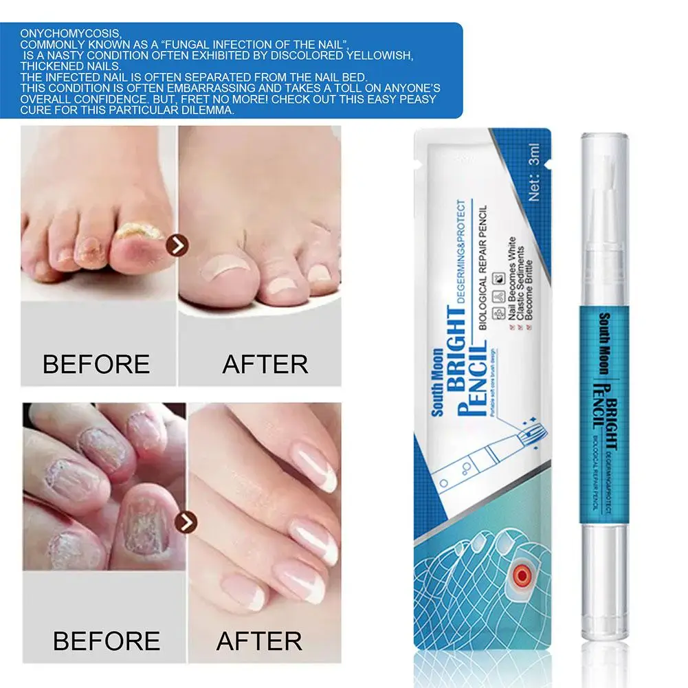 Caneta líquida para reparo de unhas, 2 peças, tratamento de fungos nas unhas, soro, creme para os dedos dos pés, gel anti-remoção, reparação de fungos nos pés, infecção líquida