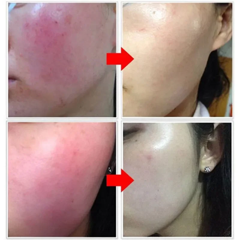 7 Tage Reparatur Gesichts rötung Creme beruhigende Rötung Reparatur Haut Rosacea rotes Blut verbessern empfindliche Hautpflege koreanische Kosmetik