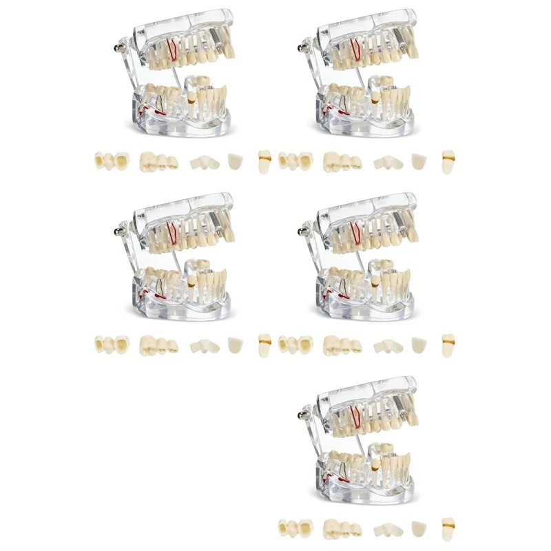 5X Disease Teeth Model Typodonts Implant Teeth Model With Removable Teeth Dentist Standard Tooth Demonstration