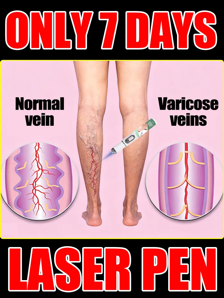 

The new blue light pen can solve varicose veins.