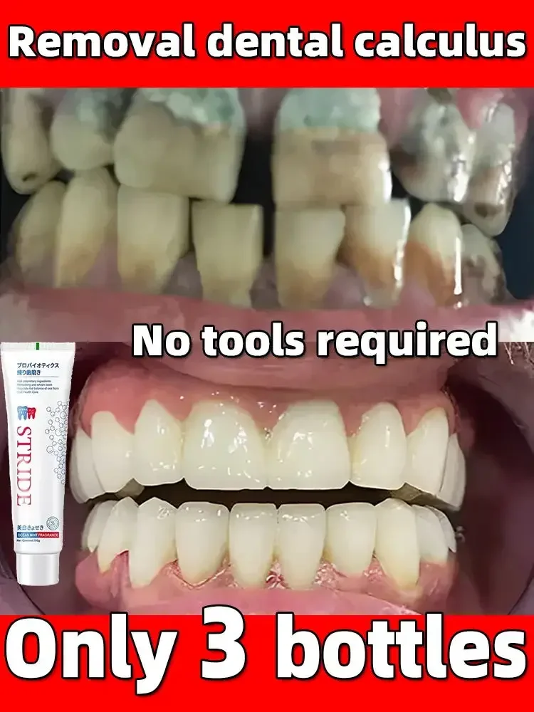 Dental Calculus Remover Whitening Teeth Mouth Odour Removal Tooth Stains Bad Breath Preventing Periodontitis Fresh Breath 2024