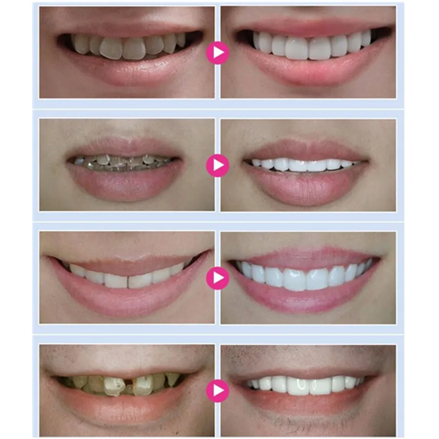 35% CP Professionelle Dental Zahnarzt Zähne Bleaching Bleichen System Helle Weiß Zahn Bleaching Gel Entfernen Gelb Staintools