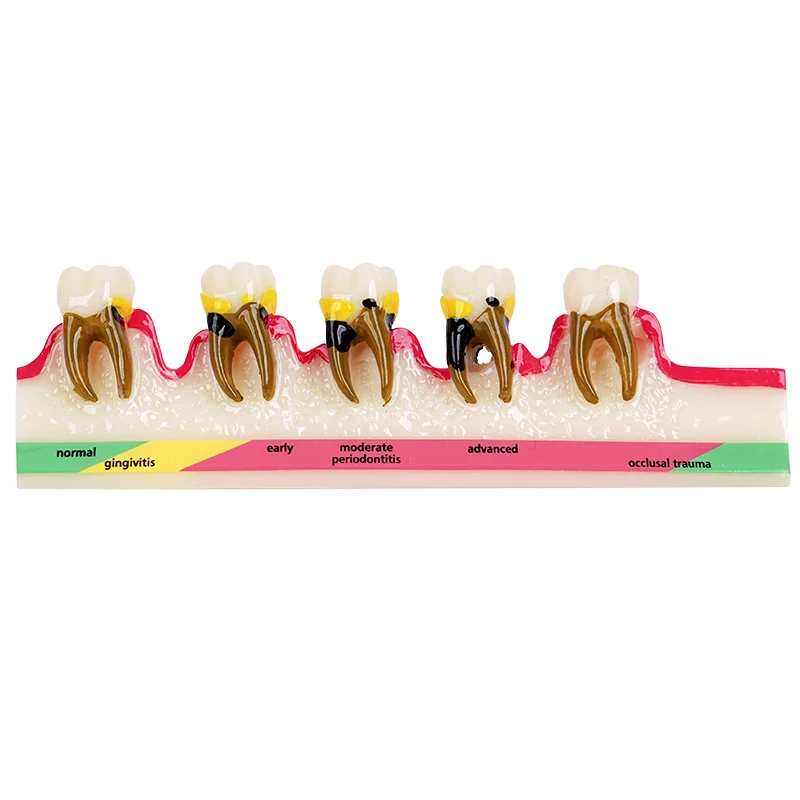 1PC Periodontal model, oral dental resin teaching model, doctor-patient communication display simulation teaching model