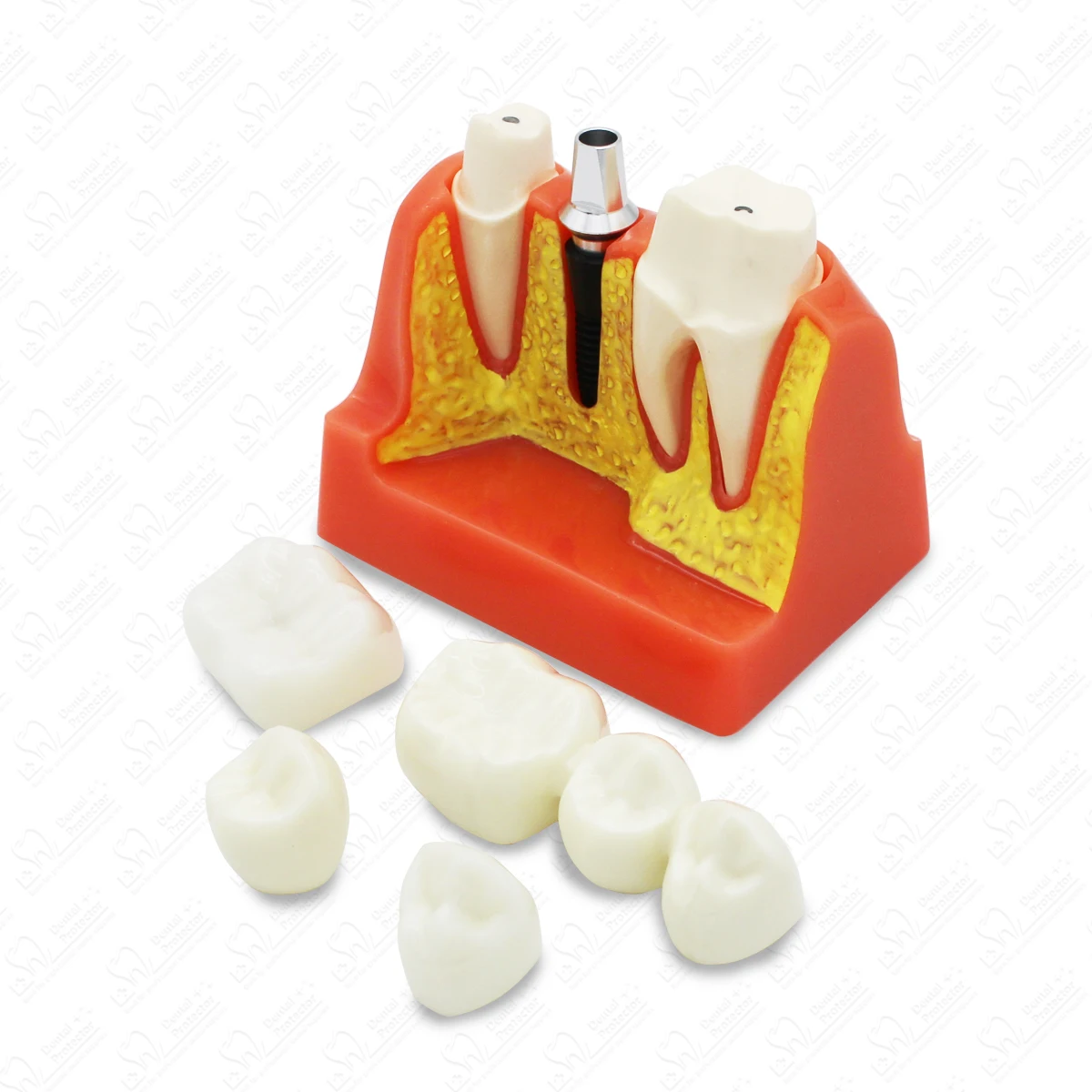 زراعة الأسنان تعليم جسر التاج نموذج قابل للإزالة الخزف نموذج لشكل الأسنان نموذج مظاهرة الأسنان لتدريس طبيب الأسنان